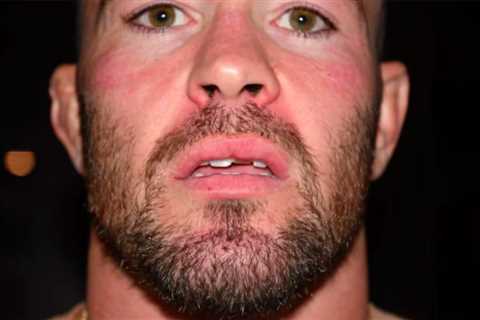 UFC star Colby Covington shows off chipped tooth and facial injuries after being attacked by Jorge..