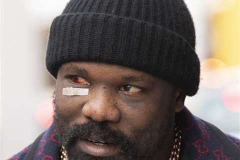 Derek Chisora shows off gruesome-looking eye injury after Tyson Fury defeat as he shops for scented ..