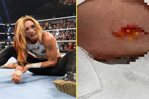 Becky Lynch shares graphic photo of gruesome injury she suffered during WWE title fight